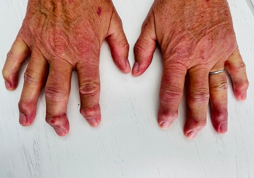 gouty arthritis hands