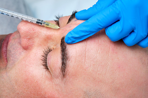 close-up injecting botulinum toxin between the eyebrows of a man for wrinkle reduction