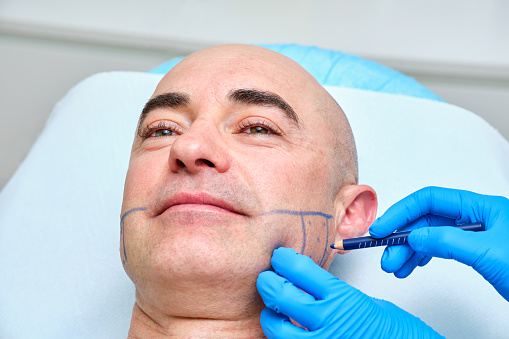 Marking the face of a man with a blue dermographic pencil for treatment in an aesthetic medicine clinic with botulinum toxin for bruxism