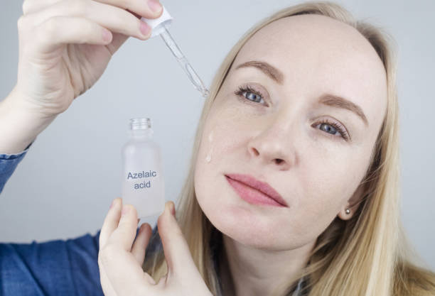 Azelaic acid. The girl applies azelainates to her face. Laboratory research. Facial skin care. Dermatological serum. Emulsion for the treatment of rosacea, acne and skin problems stock photo