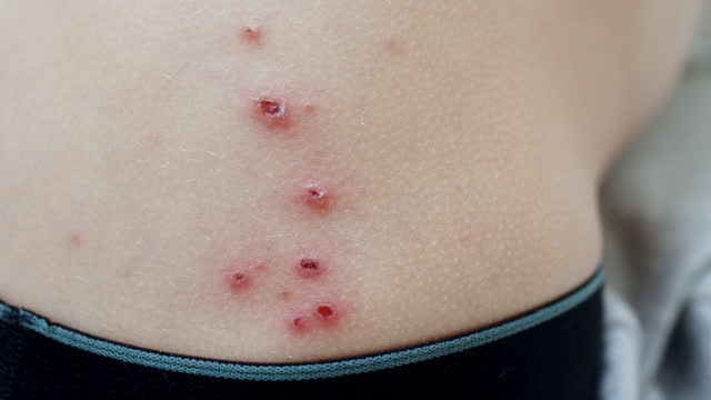 Unrecognizable ill child with chickenpox blisters on skin