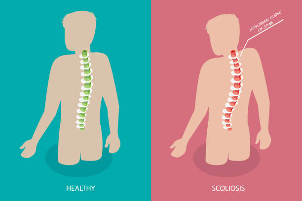 3d 아이소메트릭 플랫 벡터 척추측만증의 개념적 그림 - human spine chiropractor three dimensional shape healthcare and medicine stock illustrations