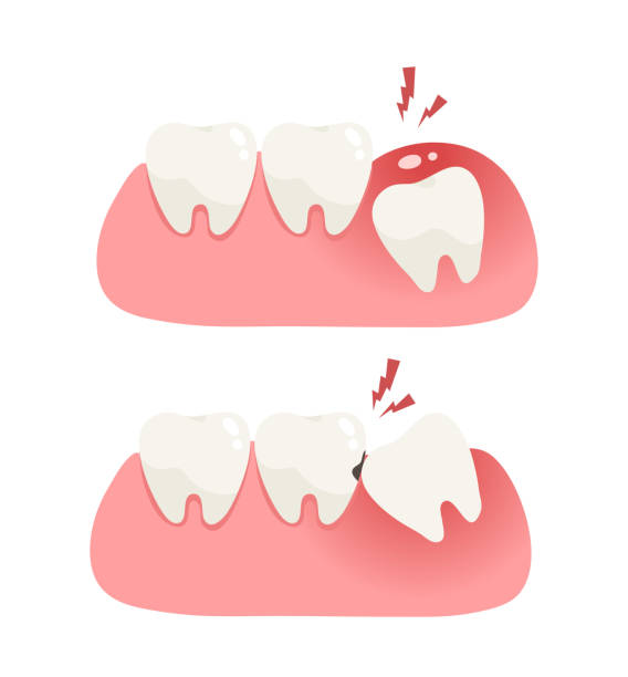Illustration of wisdom tooth under gum cause of pain and lean on other teeth cause of tooth decay. Concept of pain in mouth, toothache, impacted tooth, oral and dental health, dentistry. Flat vector. wisdom-teeth stock illustrations
