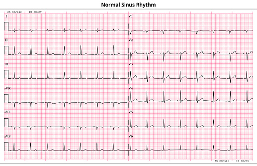 Normal Ecg Examples Ecg Normal Sinus Rhythm 12 Lead Ecg Common Case 6 Sec Lead Stock ...