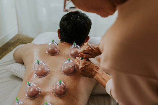 Asian adult man with back pain from office syndrome treating his pain with Chinese cupping therapy.