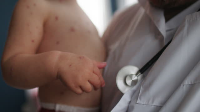 Doctor holding a child with chickenpox