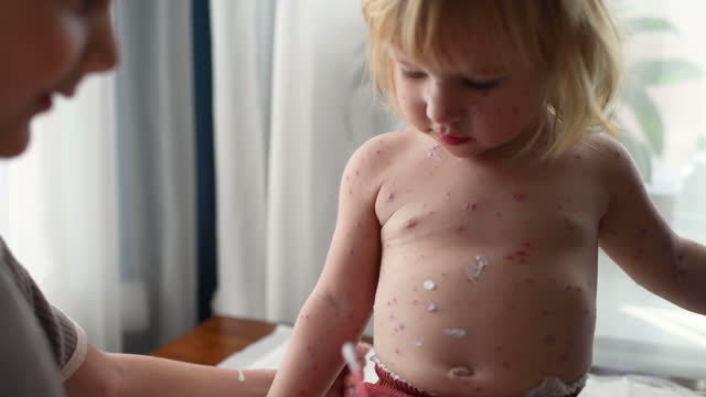 Little boy applies antiseptic medicine to his ill sister with chickenpox