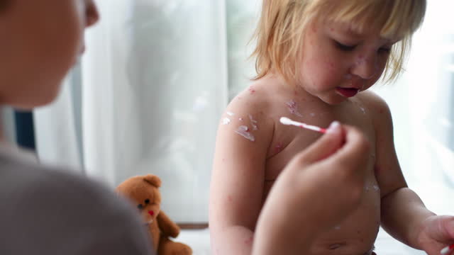 Little boy applies antiseptic medicine to his ill sister with chickenpox