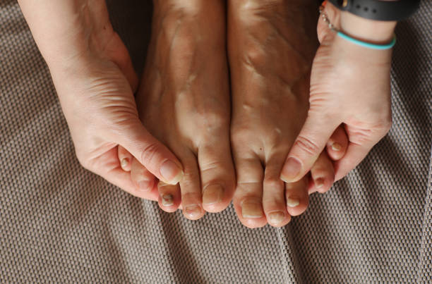 Female showing feet with subungual hematoma, black toenails caused by trauma, fungal infection or chemotherapy. Person suffering from onychomycosis, a fungal infection causing yellowing of the toenail Female showing feet with subungual hematoma, black toenails caused by trauma, fungal infection or chemotherapy.Person suffering from onychomycosis, a fungal infection causing yellowing of the toenail hematoma images stock pictures, royalty-free photos & images
