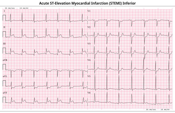 ekg akuter stemi (st-elevation myokardinfarkt) - 12 elektrode-ekg häufiger fall - 6 sek./ableitung - herzkammer stock-grafiken, -clipart, -cartoons und -symbole