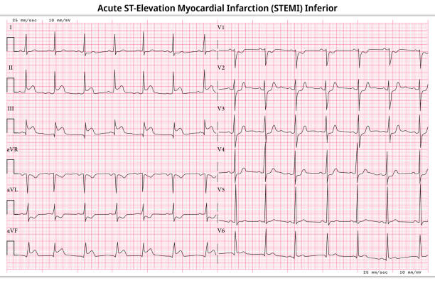 illustrations, cliparts, dessins animés et icônes de ecg stemi aigu (infarctus du myocarde avec élévation du segment st) - 12 cas commun ecg à 12 dérivations - 6 sec/plomb - fréquence cardiaque