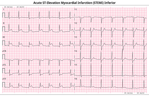 ECG Acute STEMI (ST-Elevation Myocardial Infarction) - 12 Lead ECG Common Case - 6 Sec/Lead - Vector Illustration