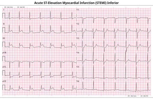Vector illustration of ECG Acute STEMI (ST-Elevation Myocardial Infarction) - 12 Lead ECG Common Case - 6 Sec/Lead
