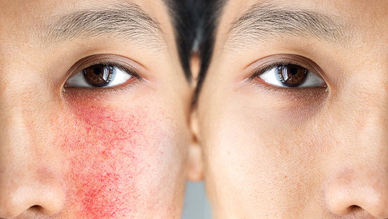 Before and after a treatment for rosacea in an asian man's face