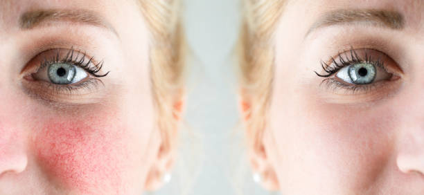 istock Before and after laser treatment for rosacea 1475882674