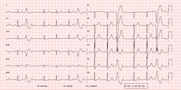 ECG example of 12-lead rhythm,  Wide QRS supraventricular extrasystole vector art illustration