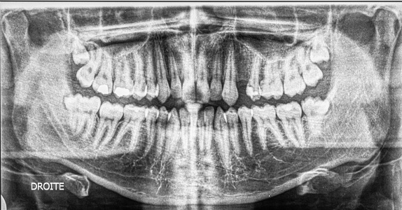 Dental phenomenon that appears to be two teeth developed from one. French text meaning \