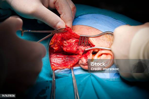 종양 수술 피에 대한 스톡 사진 및 기타 이미지 - 피, 수술, 메스-수술 장비