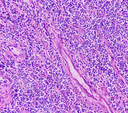 Olfactory neuroblastoma and Non-Hodgkin's lymphoma. Smear show fragmented piece of soft tissue. Malignant neoplasm of atypical small round cells by respiratory epithelium.