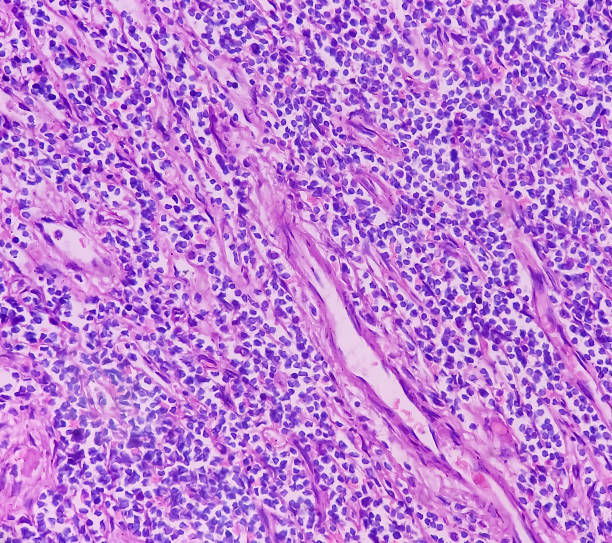 olfactory neuroblastoma and non-hodgkin's lymphoma. - non hodgkin lymphoma imagens e fotografias de stock