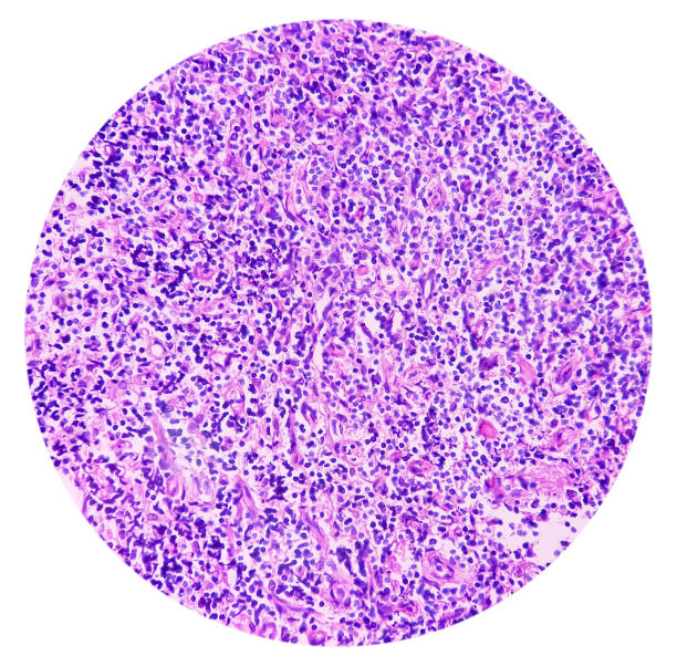olfactory neuroblastoma and non-hodgkin's lymphoma. - non hodgkin lymphoma imagens e fotografias de stock