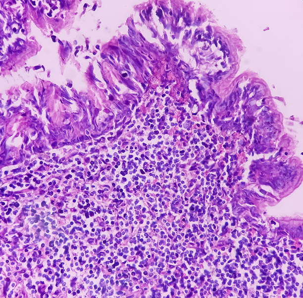 istock Olfactory neuroblastoma and Non-Hodgkin's lymphoma. 1476359334