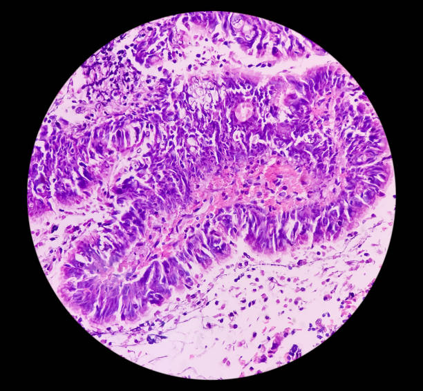 neuroblastoma olfativo e linfoma não-hodgkin. - non hodgkin lymphoma - fotografias e filmes do acervo