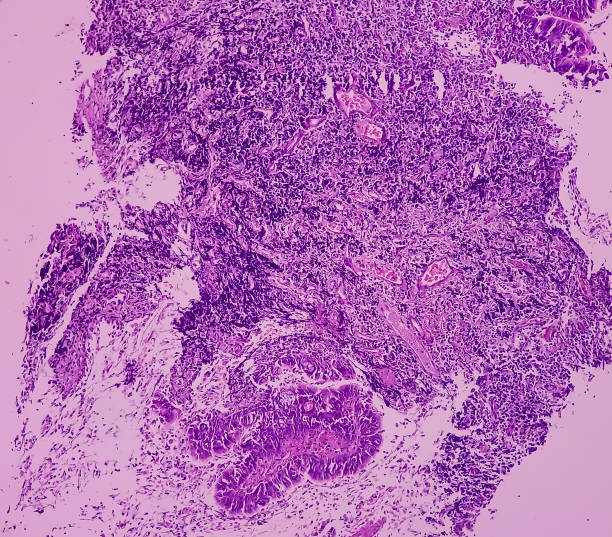 olfactory neuroblastoma and non-hodgkin's lymphoma. - non hodgkin lymphoma imagens e fotografias de stock