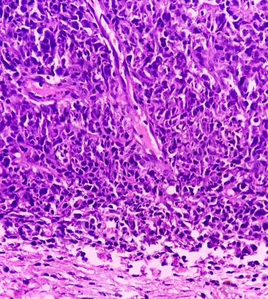 Sarcoma Example 130+ Soft Tissue Sarcoma Stock Photos, Pictures & Royalty-Free Images ...