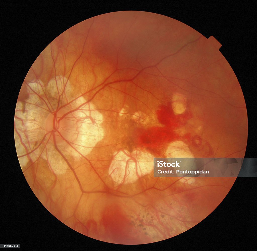 Retina Human eye Glaucoma Stock Photo