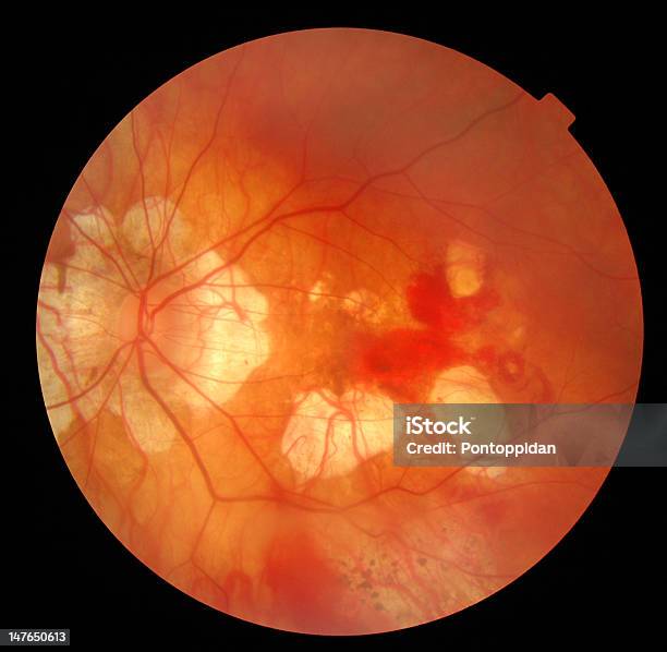 Retina Stock Photo - Download Image Now - Glaucoma, Retina, Adult