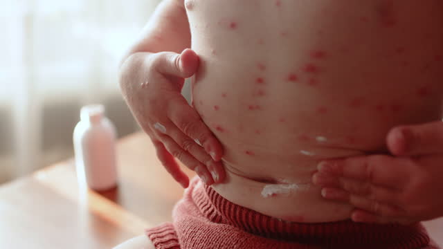 Little girl with chickenpox all over her body at home