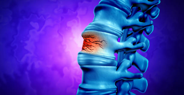 fractura traumática de la columna vertebral - parálisis fotografías e imágenes de stock