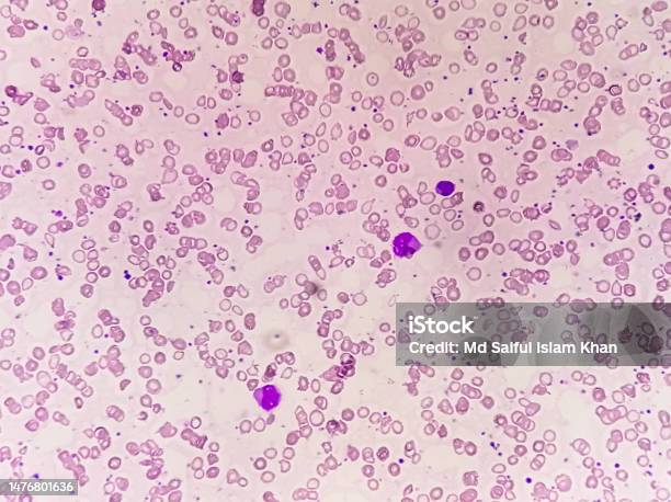 Anisocytose plaquettaire grossesse