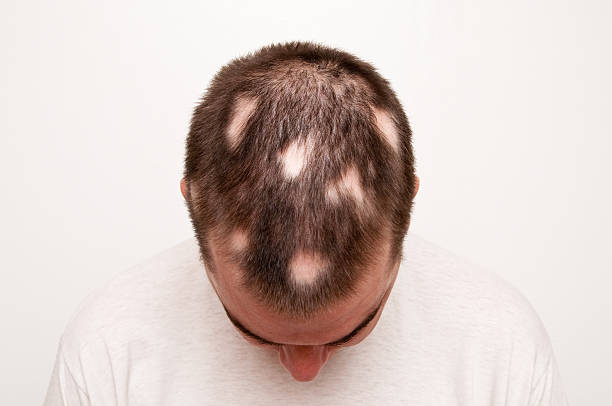 homme avec alopecia - human scalp photos et images de collection