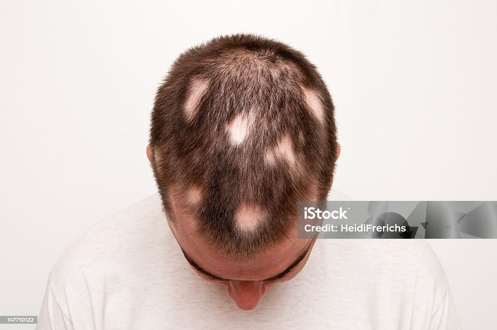 Man With Alopecia Stock Photo - Download Image Now - Bald Patch, Balding,  Top Of Head - iStock