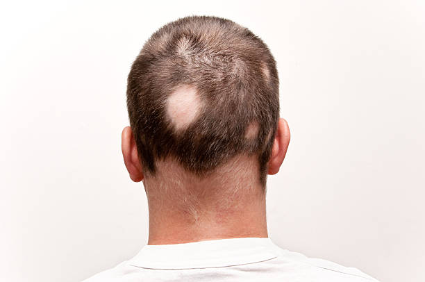 男性、alopecia - bald patch ストックフォトと画像