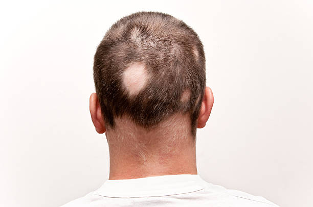 2,706 Male Pattern Baldness Stock Photos, Pictures & Royalty-Free Images - iStock | Male pattern baldness doctor 2,706 Male Pattern Baldness Stock Photos, Pictures & Royalty-Free Images - iStock | Male pattern baldness doctor