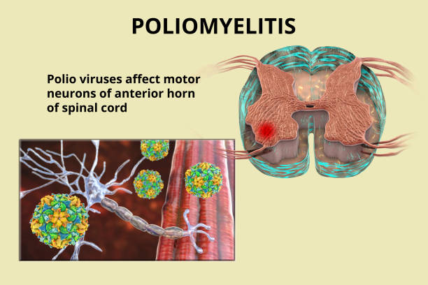 vírus da poliomielite que afetam neurônios motores - paralytic - fotografias e filmes do acervo
