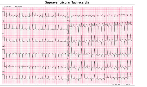 istock ECG Supraventricular Tachycardia (SVT) - 12 Lead ECG Common Case - 6 Sec/lead 1477218319
