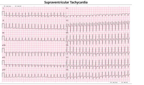 Vector illustration of ECG Supraventricular Tachycardia (SVT) - 12 Lead ECG Common Case - 6 Sec/lead