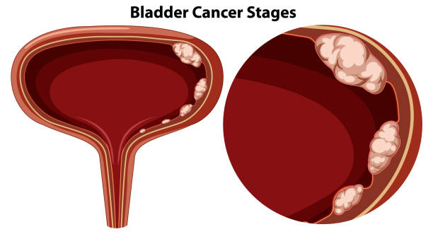 Bladder Cancer Stock Illustrations, Royalty-Free Vector Graphics & Clip Art - iStock | Bladder cancer patient, Bladder cancer smoking, Bladder cancer man