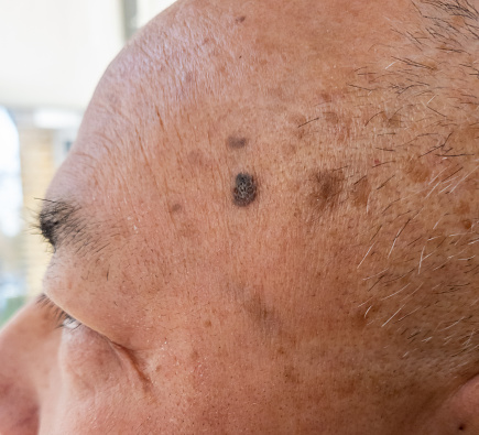 Close up of a skin mole, melanoma on a person.
