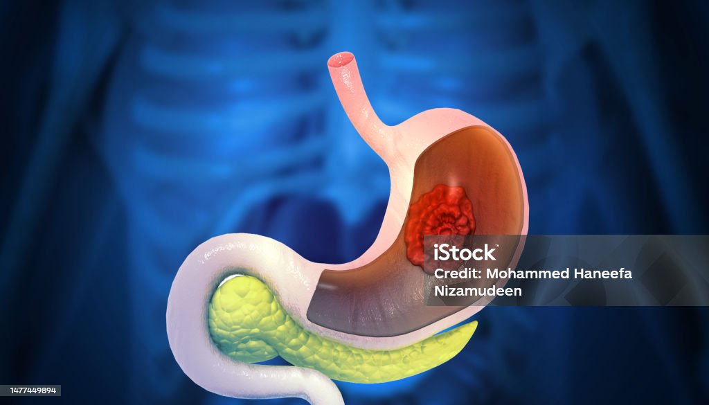 Stomach Cancer Gastric Cancer Symptoms Stages Treatment 3d Illustration ...