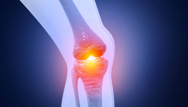 istock Pain in knee joint. Tendon problems and Joint inflammation on dark background. 3d illustration 1477450139