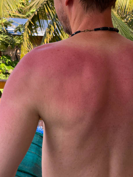 Close-up image of back of unrecognisable man sunburned pale skin, bright pink sun damaged back and shoulders, freckles and moles, heatstroke, sun protection, focus on foreground stock photo