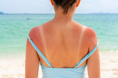 Sunburned skin on shoulder and back of a woman because of not using cream with sunscreen protection. Red skin sun burn after Sunbathing at the beach. Summer and holiday concept. Close up