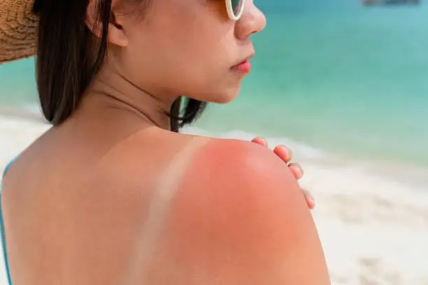 Photo of Sunburned skin on shoulder of a woman because of not using cream with sunscreen protection. Red skin sun burn after Sunbathing at the beach. Summer and holiday concept