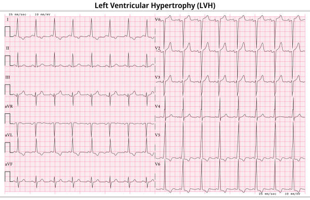 illustrazioni stock, clip art, cartoni animati e icone di tendenza di ecg ipertrofia ventricolare sinistra (lvh) - allargamento ventricolare sinistro - 12 ecg di derivazione caso comune - 6 sec/derivazione - human heart pulse trace heart valve cardiac conduction system