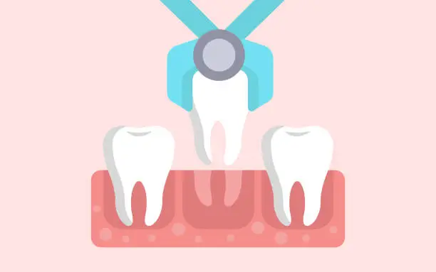 Vector illustration of tooth extraction flat vector illustration design